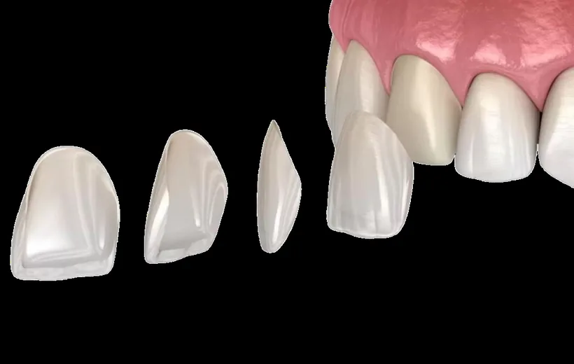 Faccette dentali Albania