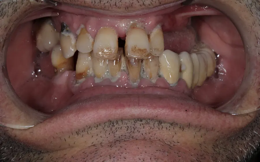 Prima del trattamento dentale, dettaglio intraorale autorizzato