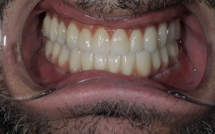 Dopo il trattamento dentale, dettaglio intraorale autorizzato