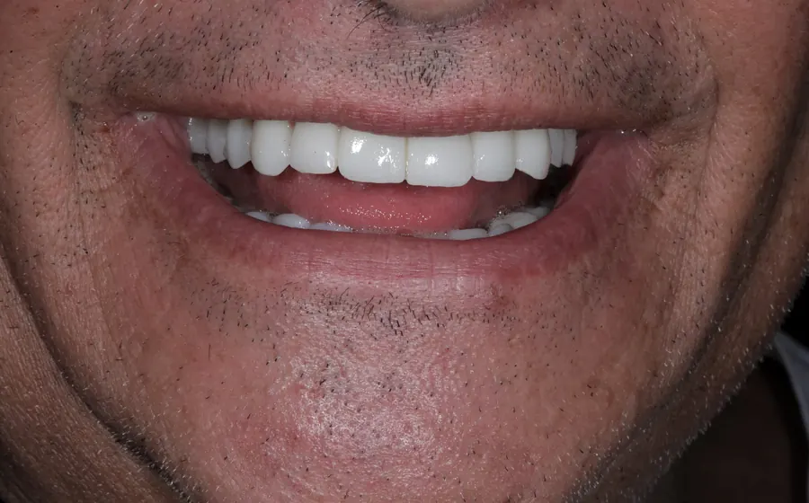 Dopo il trattamento, dettaglio sorriso autorizzato
