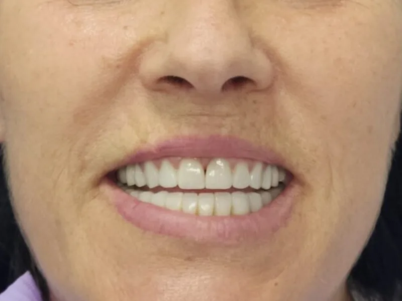 Sorriso naturale - caso clinico documentato