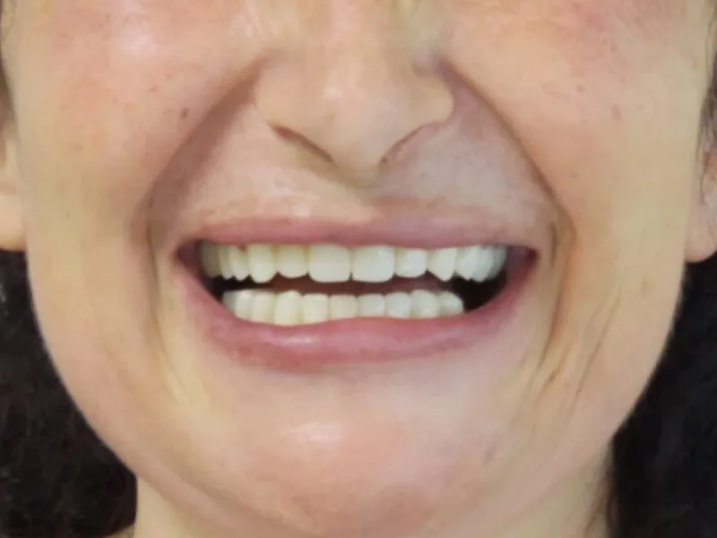 Full smile - caso clinico documentato