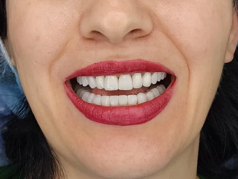 Hollywood Smile - caso clinico documentato